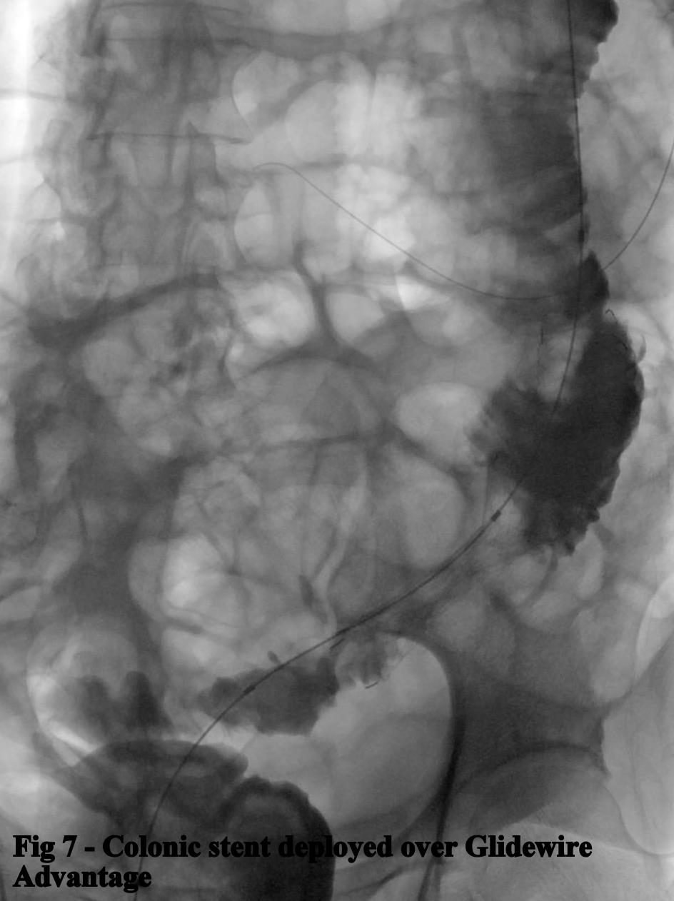 Fig 7. Colonic stent deployed over Glidewire Advantage